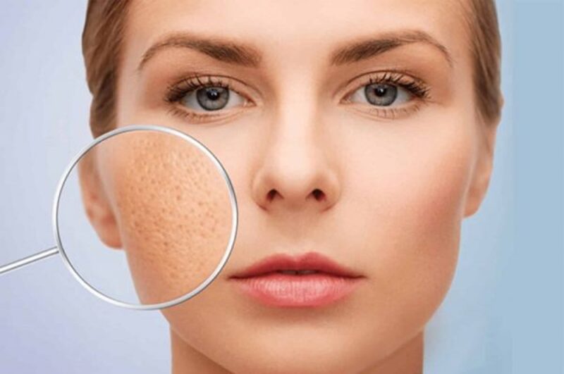 cách trị lỗ chân lông to cho da dầu